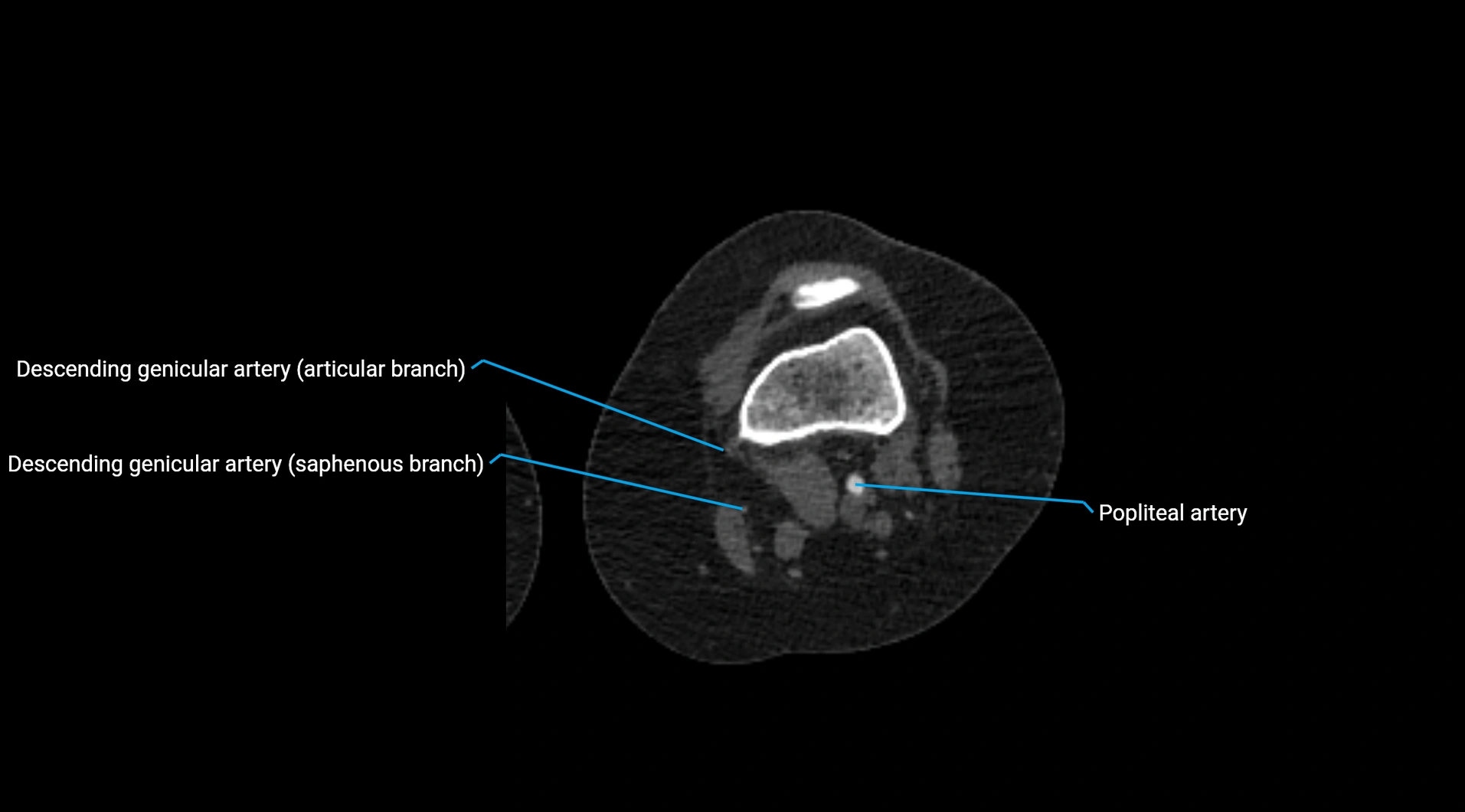 CTA lower limb cross sectional anatomy labelled image _167.webp